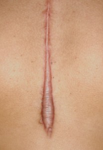 Remove Unwanted Scars With Scar Revision
