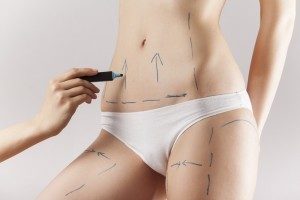 Liposuction | Calgary, Alberta